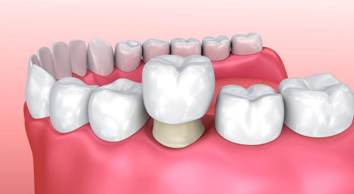 Bọc răng sứ có tốt không? Trường hợp nào nên thực hiện?