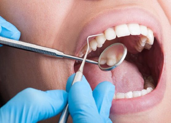 Lấy cao răng có tốt không? Bao lâu thì nên lấy cao răng?